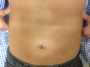 2 months PostOp